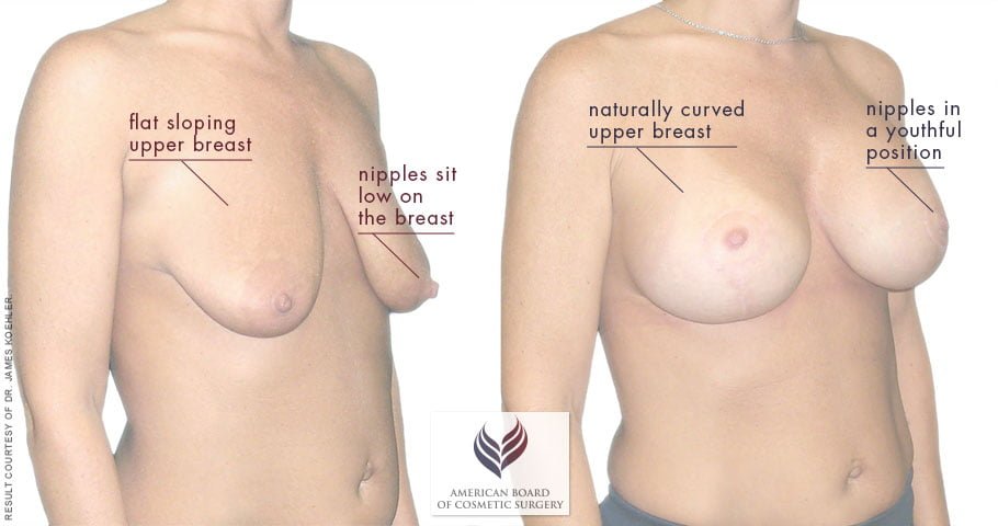 A breast lift with augmentation is a popular option to enhance the breasts.