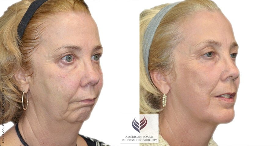 Before and after facelift surgery