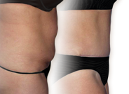 Cellulite Reduction Treatments Abcs