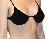 Breast Reduction Surgery Guide