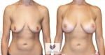 abcs-breast-augmentation-01a-pancholi