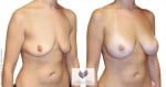 abcs-breast-augmentation-01b-pancholi