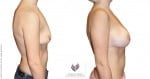 abcs-breast-augmentation-01c-pancholi