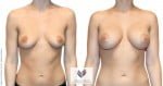abcs-breast-augmentation-02a-pancholi