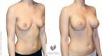abcs-breast-augmentation-02b-pancholi