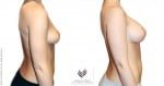 abcs-breast-augmentation-02c-pancholi