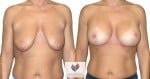 abcs-breast-lift-aug-01a-koehler