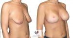 abcs-breast-lift-aug-01b-koehler