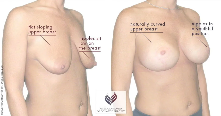 Small saggy breasts discount