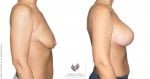 abcs-breast-lift-aug-01c-koehler