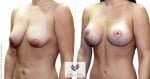 abcs-breast-lift-aug-02b-koehler