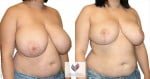abcs-breast-reduction-01b-koehler