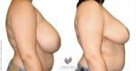 abcs-breast-reduction-01c-koehler