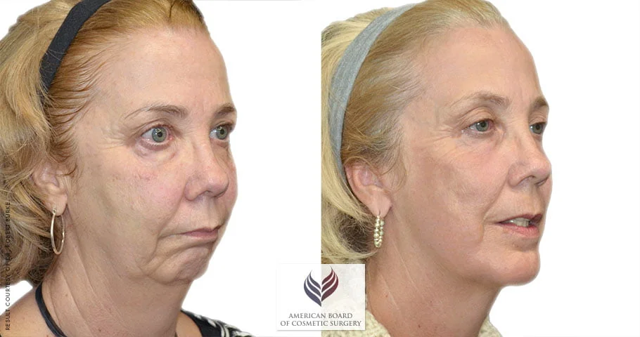 Facelift Surgery Guide  The American Board of Cosmetic Surgery