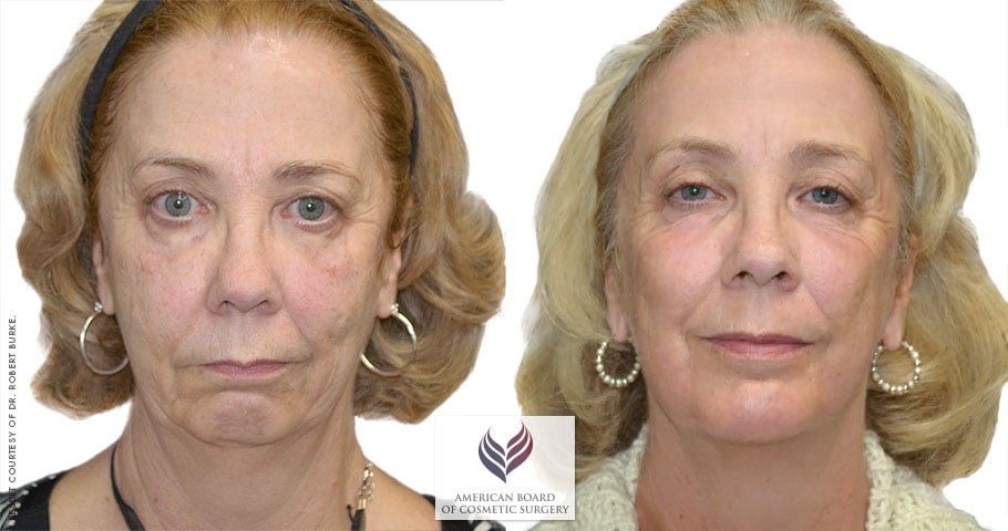 Facelift & Neck Contouring