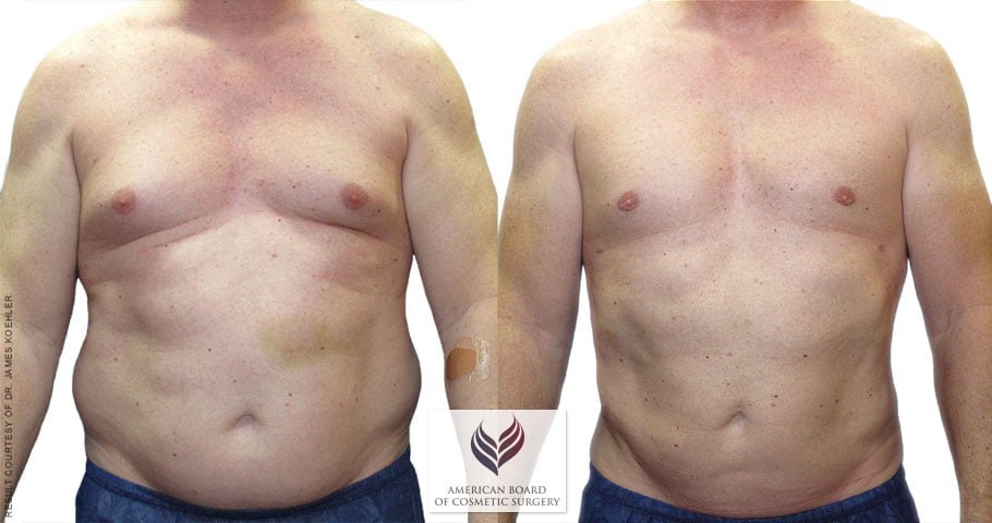 Gynecomastia & Liposuction