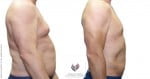 abcs-gynecomastia-01b-koehler