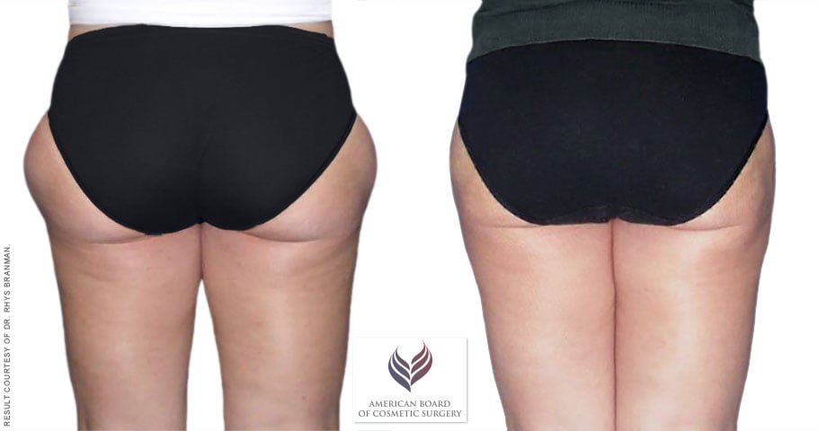 Before and after fat removal with lipo surgery