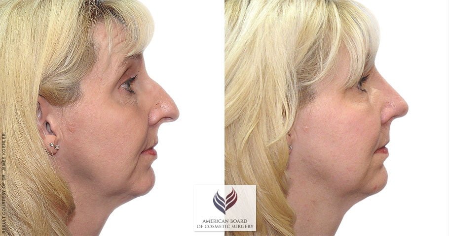 Rhinoplasty