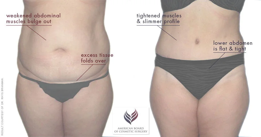 How to Choose Between Liposuction and Noninvasive Fat Reduction Procedures  - ABCS