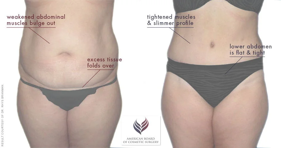 Before and after Tummy Tuck with Liposuction