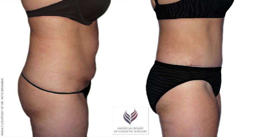 Tummy Tuck: The Ultimate Guide to Recovery & Results