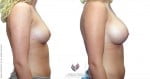 abcs-breast-augmentation-03c-koehler