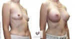 abcs-breast-augmentation-04b-koehler