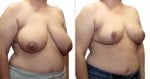 abcs-breast-reduction-02b-koehler