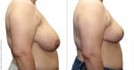 abcs-breast-reduction-02c-koehler