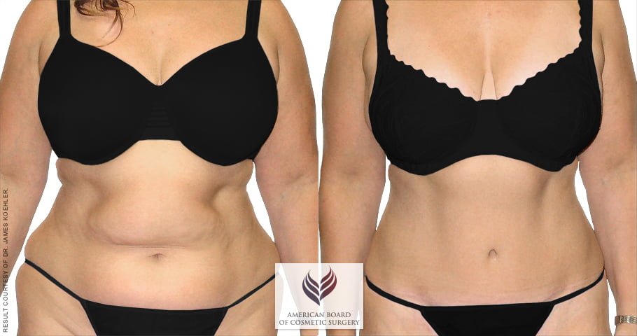 Tummy Tuck 5