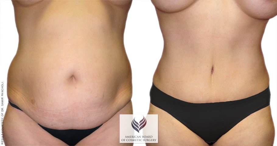 Tummy Tuck 6