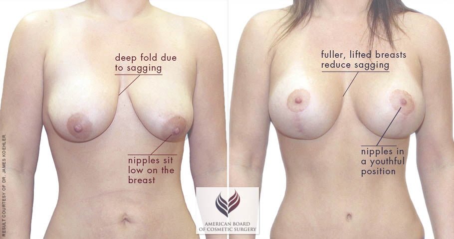 abcs-breast-lift-aug-02a-koehler-overlay