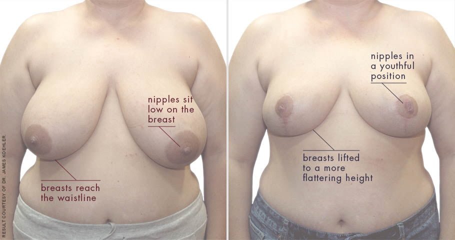 abcs-breast-reduction-02a-koehler-overlay