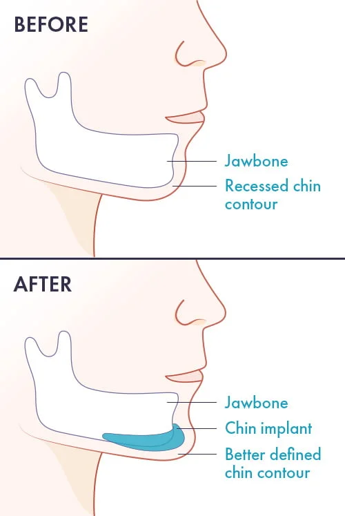 chin implant diagram