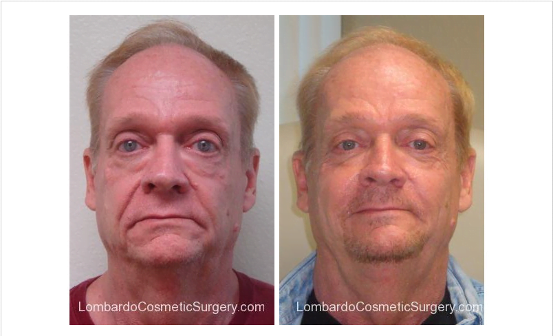 before and after male filler injections