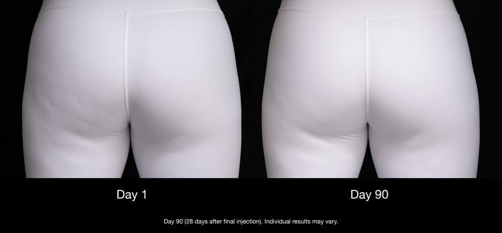 side by side images labeled day 1 and day 90 of buttocks in white leggings with less visible dimpling after QWO treatment