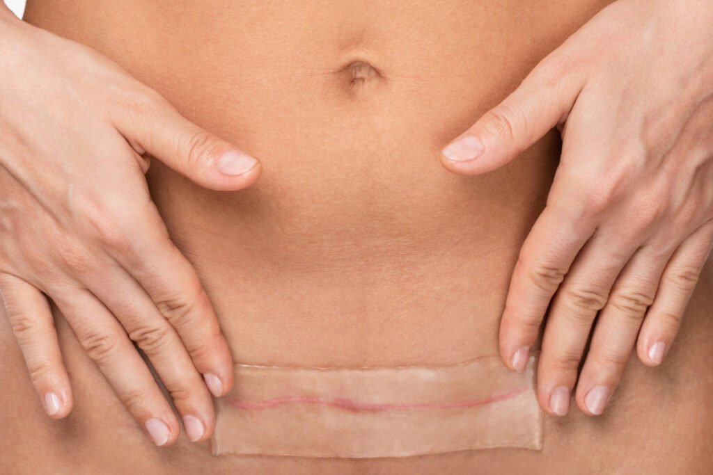 Woman with silicone patch over surgical incision