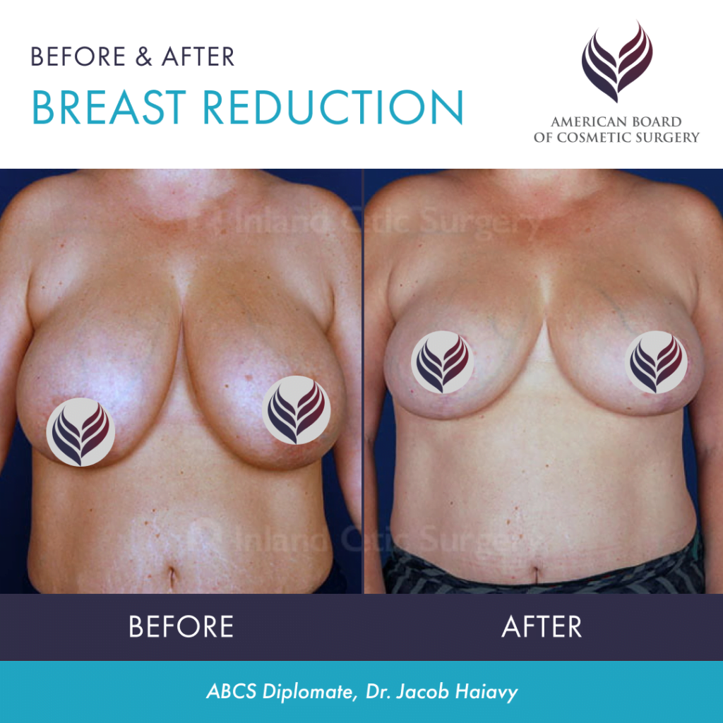 Before and after breast reduction by ABCS Diplomate Dr. Jacob Haiavy