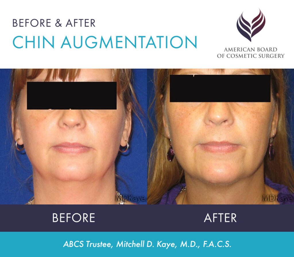 Before and After Chin Augmentation by ABCS Trustee Mitchell D. Kaye, M.D., F.A.C.S.