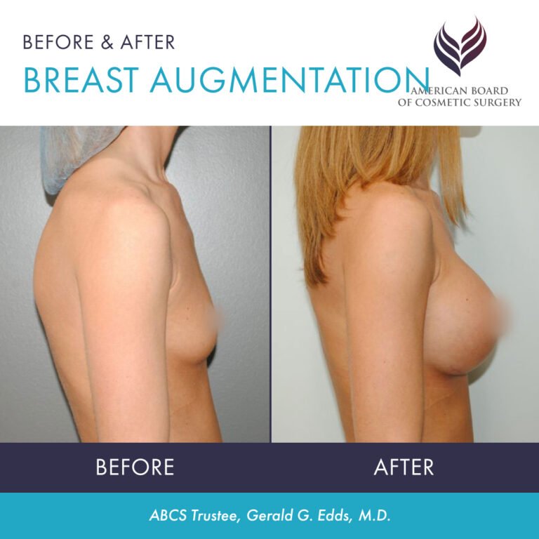 Before and after breast augmentation with ABCS Trustee Dr. Gerald G. Edds