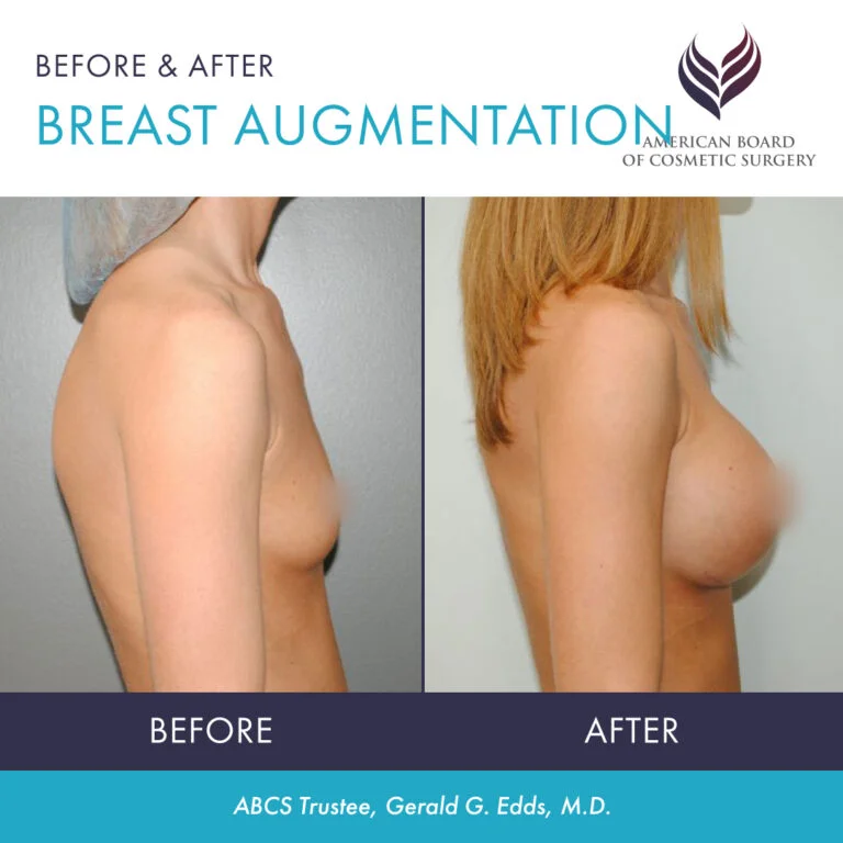 Breast Augmentation (Breast Implants)