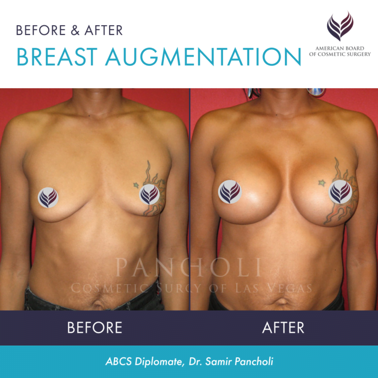 Before and after breast augmentation with ABCS Diplomate Dr. Samir Pancholi