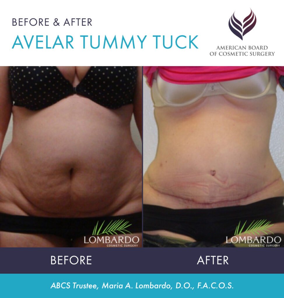 Before and after avelar tummy tuck with ABCS Trustee Dr. Maria Lombardo