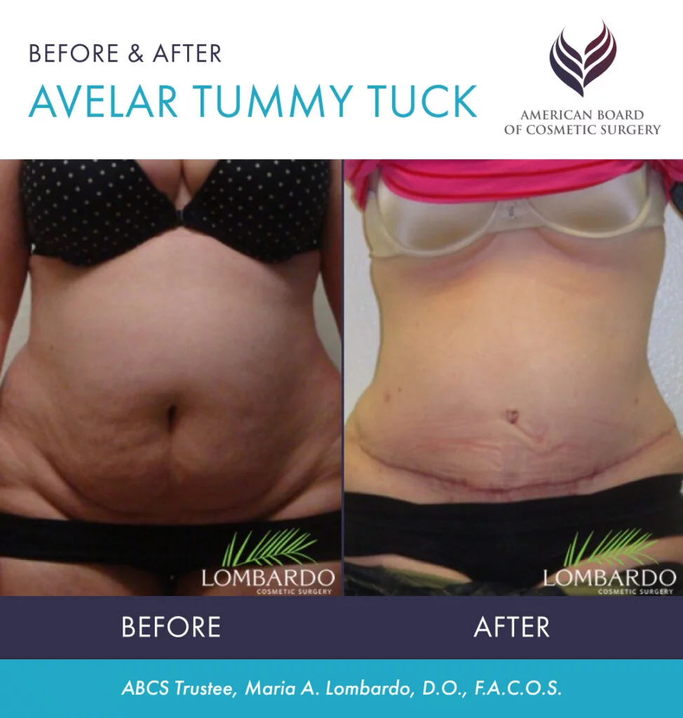 Tummy Tuck, Abdominoplasty Guide