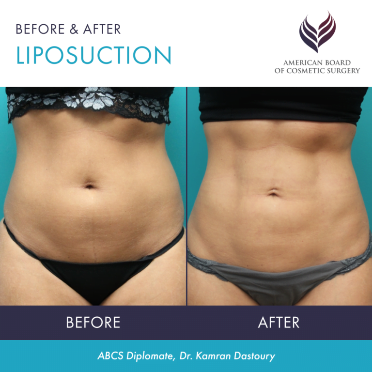 Before and after liposuction by ABCS Diplomate Dr. Kamran Dastoury
