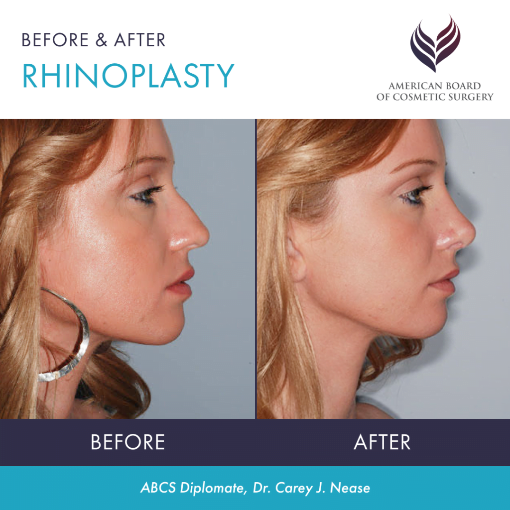 Before and after rhinoplasty by ABCS Diplomate Dr. Carey J. Nease