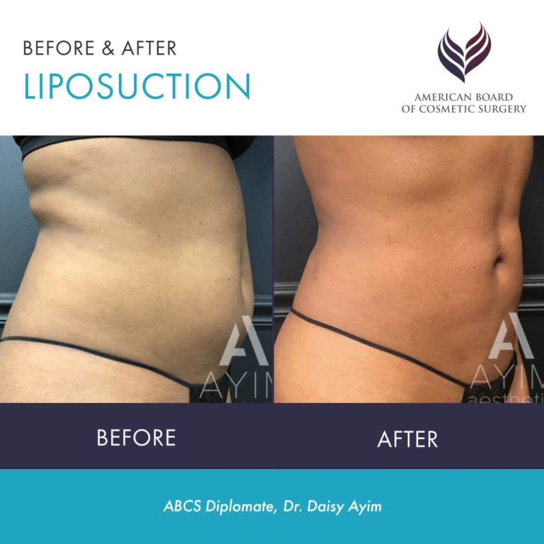 Before and after liposuction by ABCS Diplomate Dr. Daisy Ayim