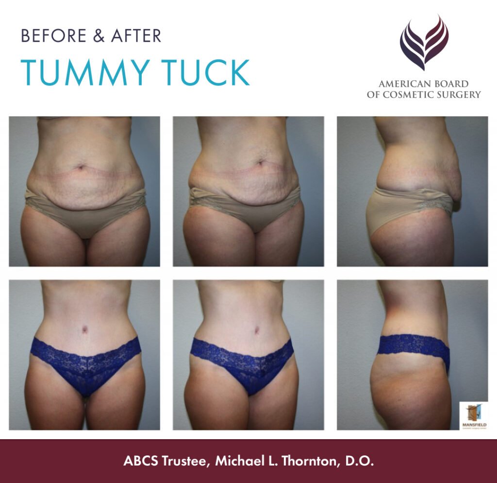 Before and after tummy tuck with ABCS Trustee Dr. Michael L. Thornton