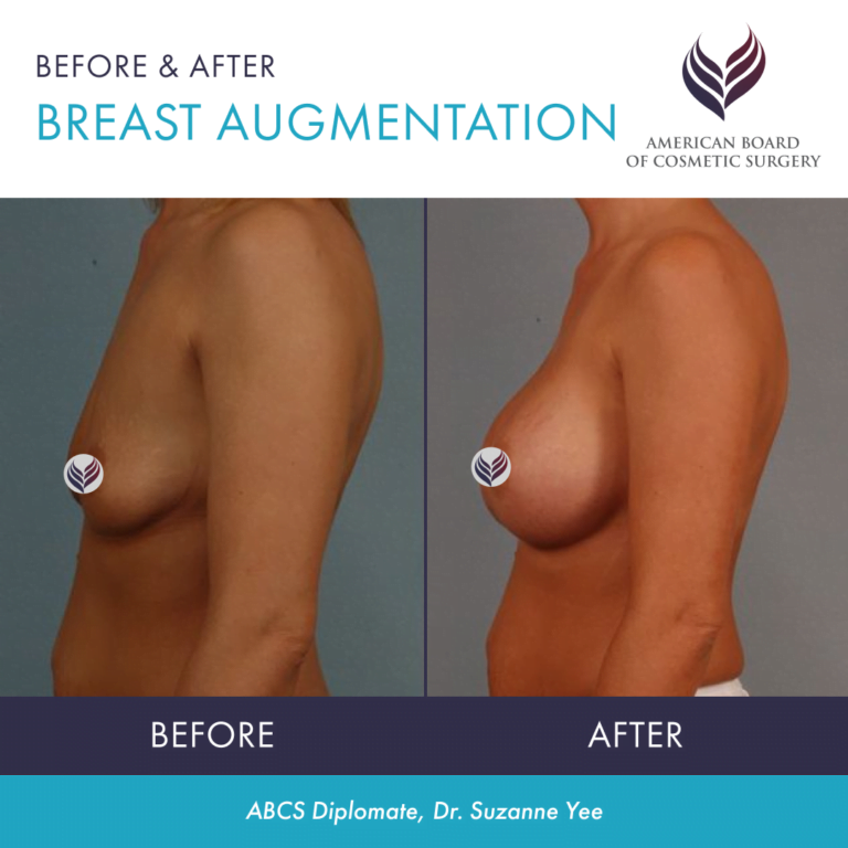 Before and after breast augmentation with ABCS Diplomate Dr. Suzanne Yee